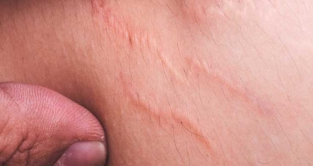 Natural Home Remedies of Stretch Marks
